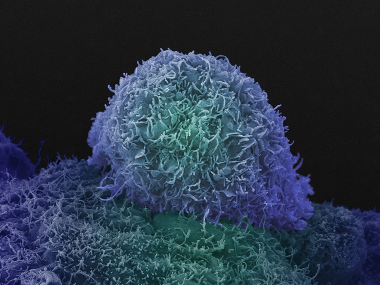 Imagen: Imagen de células de cáncer de próstata tomada usando un microscopio electrónico de barrido (Fotografía cortesía de la Unidad LRI EM)